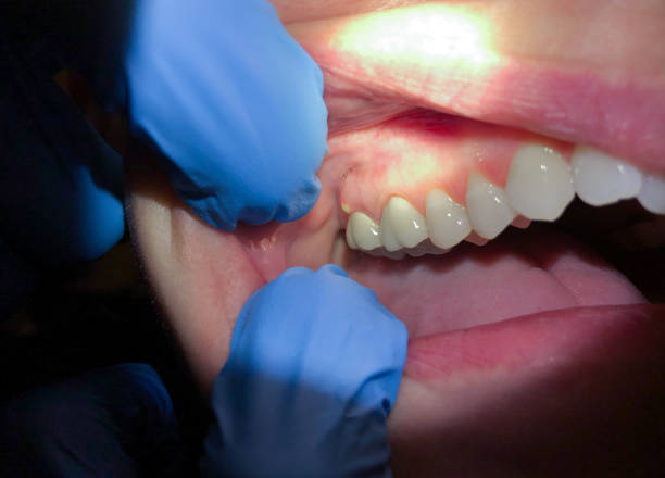 Best Emergency Wisdom Teeth Removal in Percy, IL