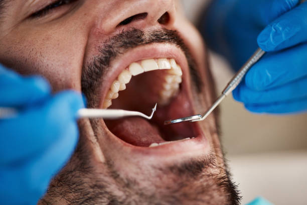 Best Emergency Tooth Extraction in Percy, IL
